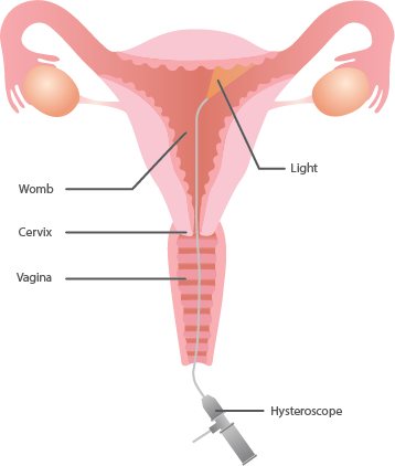 Fibroids Sepcialist in India - Dr Rishma Pai