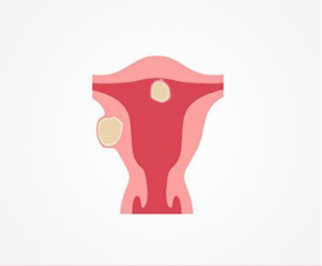 Fibroids Sepcialist in India - Dr Rishma Pai