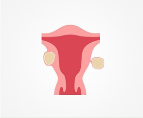 Fibroids Sepcialist in India - Dr Rishma Pai