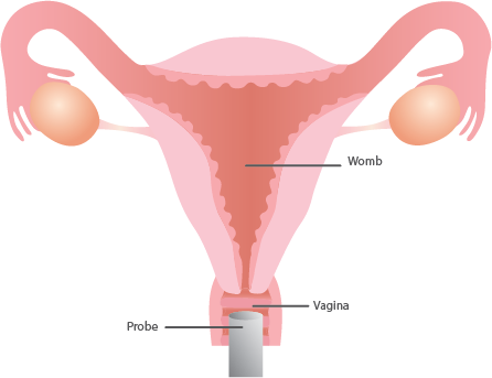 Fibroids Sepcialist in India - Dr Rishma Pai