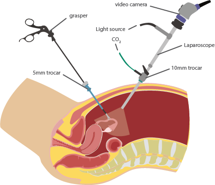 Fibroids Sepcialist in India - Dr Rishma Pai