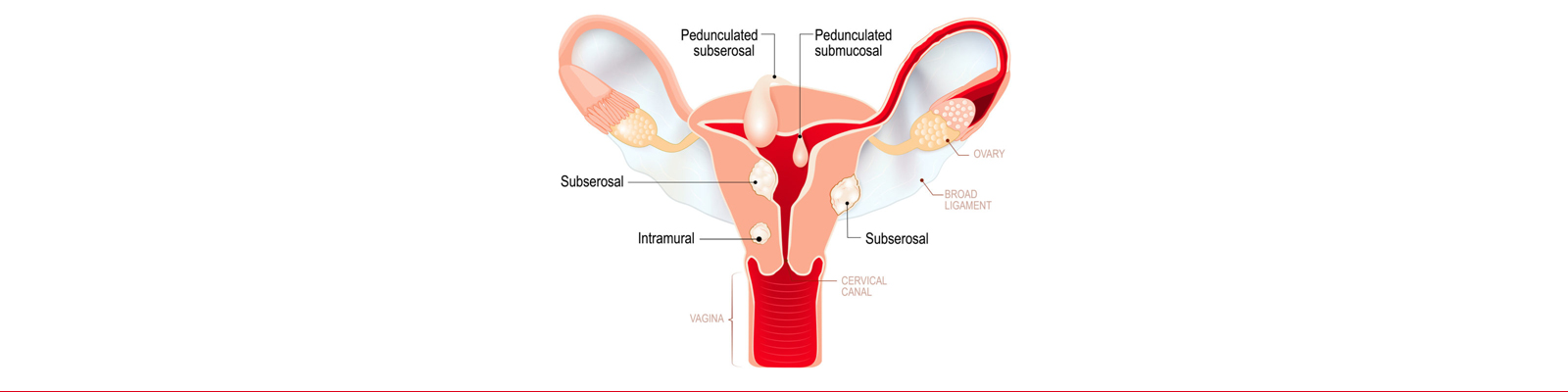 Fibroids Sepcialist in India - Dr Rishma Pai